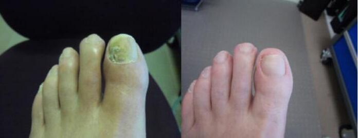 Fotos de pies antes y después de usar la crema Zenidol