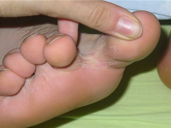 Síntomas de hongos en las uñas de los pies
