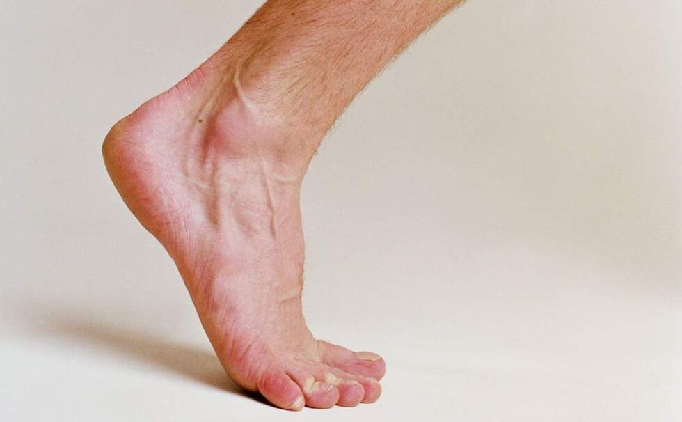sintomas del pie de atleta