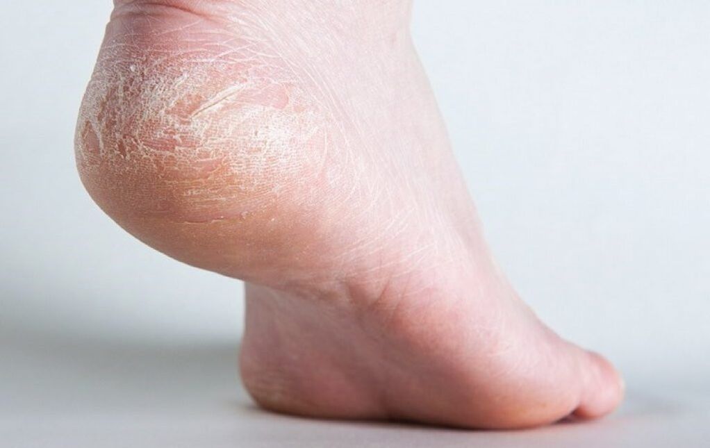 hongos en la piel de los pies