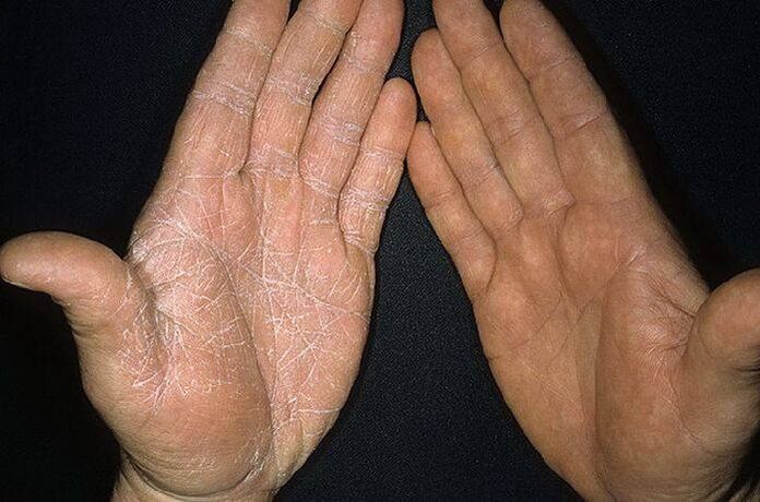 Síntomas de un hongo en la piel de las manos. 