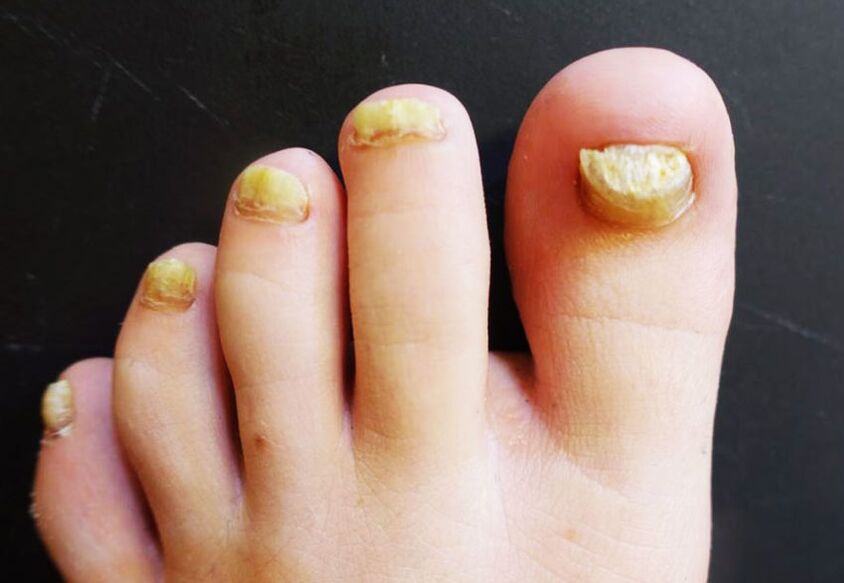Aspecto antiestético de las uñas de los pies afectadas por hongos. 
